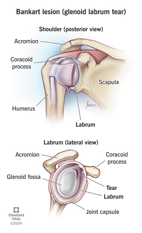 tests for glenoid labrum tear massage therapist|Bankart Lesion (Glenoid Labrum Tear) .